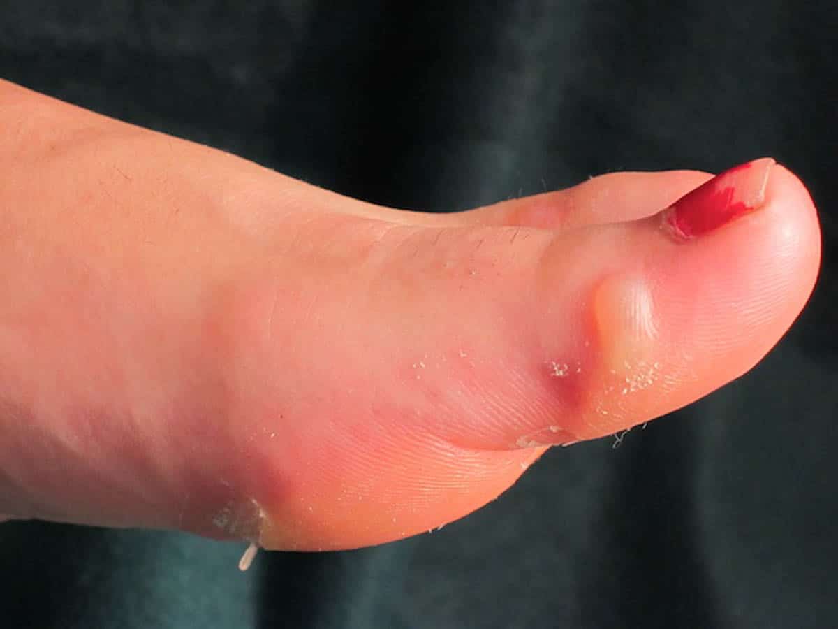 Camino de Santiago first aid foot blister
